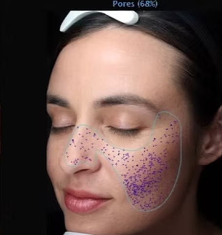 VISIA skin analysis showing pore size & distribution - detailed view of skin condition for professional assessment