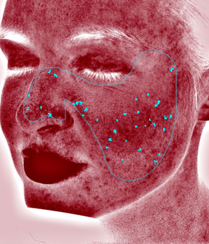 VISIA skin analysis showing redness & sensitivity - detailed view of skin condition for professional assessment