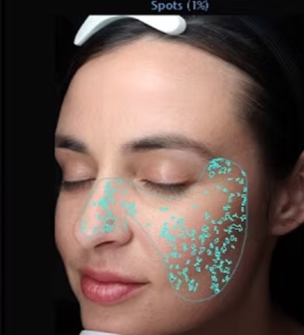 VISIA skin analysis showing spots & sun damage - detailed view of skin condition for professional assessment