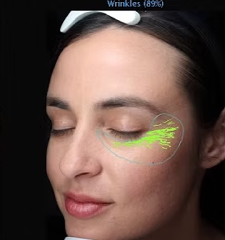 VISIA skin analysis showing wrinkles & lines - detailed view of skin condition for professional assessment